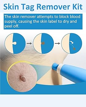 2in1 Skin Tag And Mole Remover Kit  Safe Painless AtHome Wart Removal Device 3