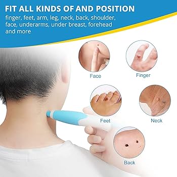 2in1 Skin Tag And Mole Remover Kit  Safe Painless AtHome Wart Removal Device 4