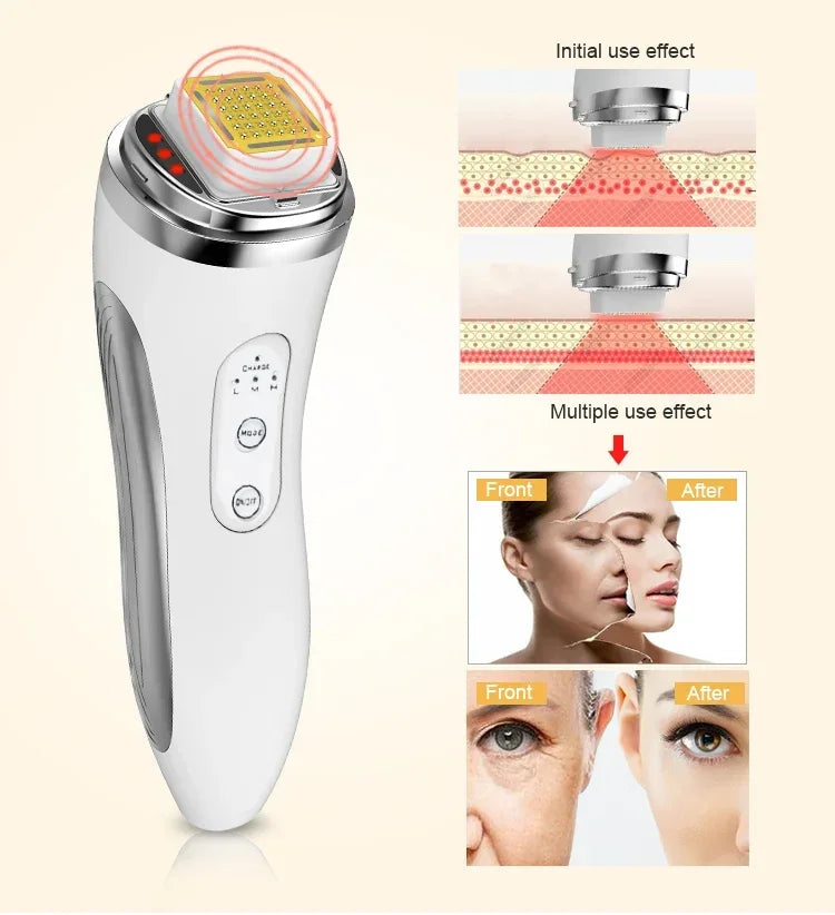 RF Radio Frequency Dot Matrix Face Lifting Massager, Skin Tightening & Wrinkle Remover Facial Machine, Home Anti-Aging