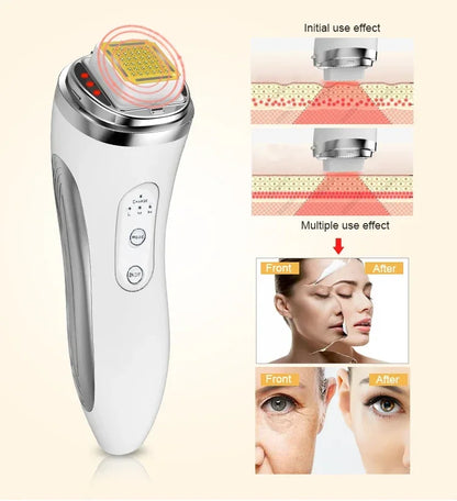 RF Radio Frequency Dot Matrix Face Lifting Massager, Skin Tightening & Wrinkle Remover Facial Machine, Home Anti-Aging