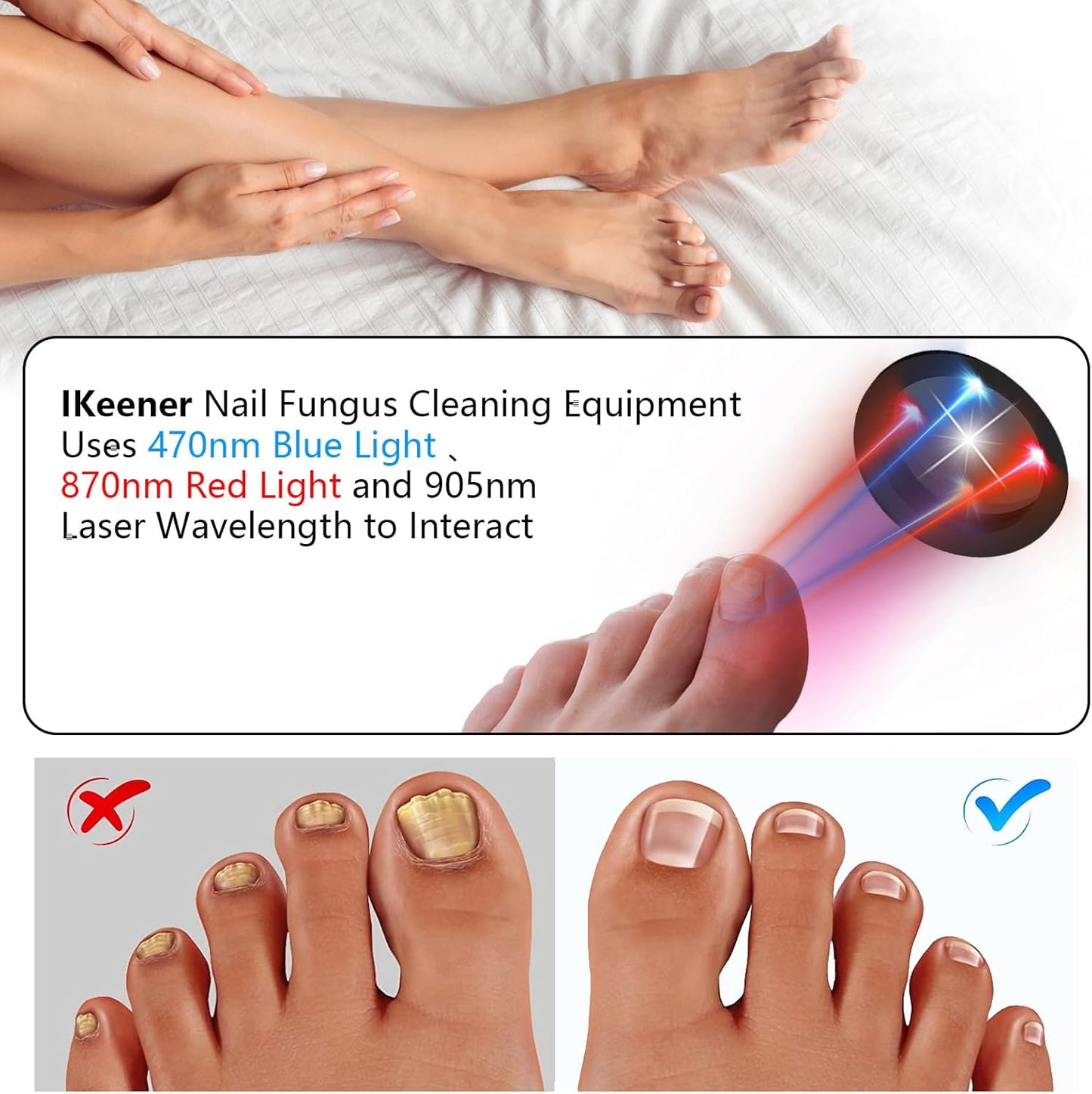 Nail Fungus Laser Device Super Pulsed Invisible Light Smart Remove and Repair Fungal Nail, Portable, Rechargeable