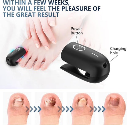 Nail Fungus Laser Device Super Pulsed Invisible Light Smart Remove and Repair Fungal Nail, Portable, Rechargeable