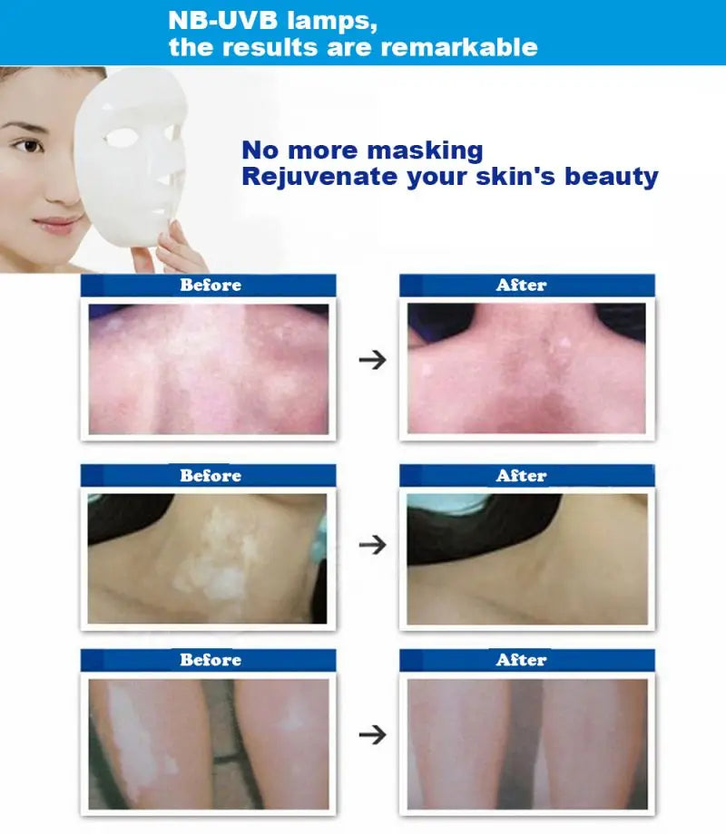 UV 311nm Ultraviolet Phototherapy Device Uses Philips Lamp UVB To Treat Vitiligo Psoriasis White Sp 3