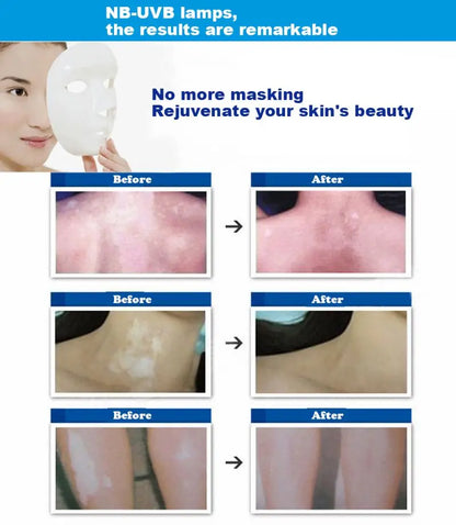 UV 311nm Ultraviolet Phototherapy Device Uses Philips Lamp UVB To Treat Vitiligo Psoriasis White Sp 3
