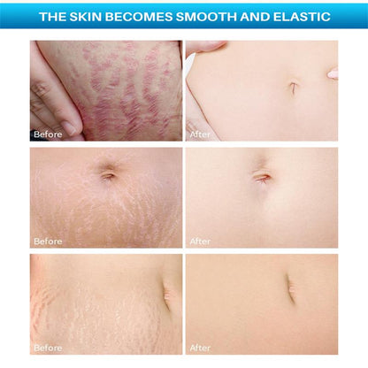 Postpartum Repair Essential Oil Fade Stretch Marks Fat Lines Big Belly Recovery Body Massage Oil Sk 1
