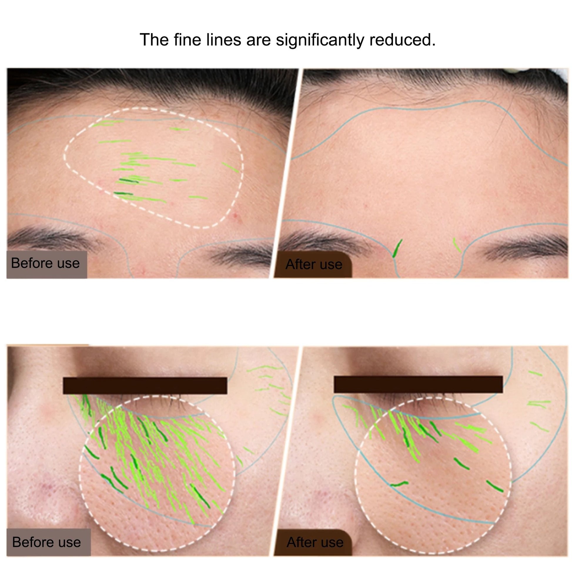 RF EMS Skin Tightening And Lifting Beauty Device For Face And Body 2