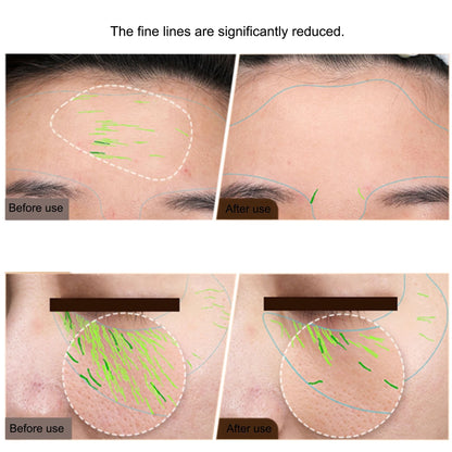 RF EMS Skin Tightening And Lifting Beauty Device For Face And Body 2