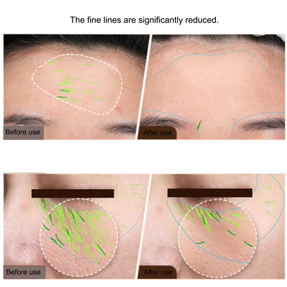 Professional RF Skin Tightening And EMS Face Lifting Device  AtHome AntiAging Beauty Machine 1